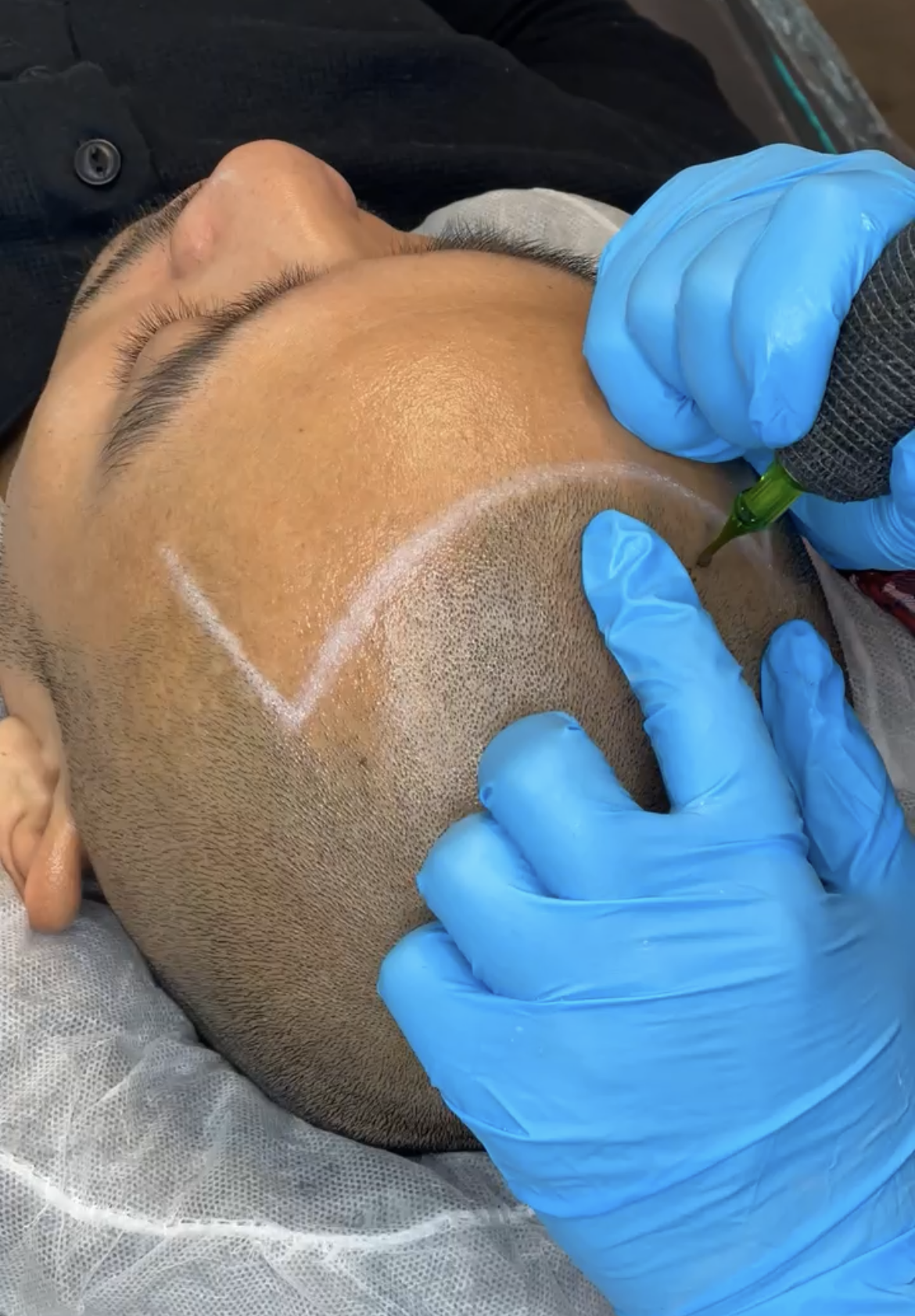 SMP Scalp Micropigmentation Tattoo  Supplies Kit-Permanent Liners For Marking(white)